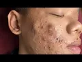 Lagu Make your Acne Treatment Huong Da Nang | 448# Hoang Part 3 | acne 2022
