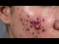 Loan Nguyen Acne Treatment 33zz