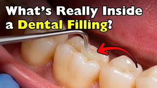 What Is Dental Resin ACTUALLY Made Of?