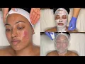 CYSTIC ACNE TREATMENT WALK-IN FACIAL FOR GRADE 3 AND 4 ACNE WITH PRO TIPS LICENSED ESTHETICIAN