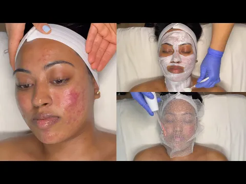 Download MP3 CYSTIC ACNE TREATMENT | WALK-IN FACIAL FOR GRADE 3 AND 4 ACNE  WITH PRO TIPS | LICENSED ESTHETICIAN