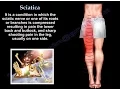 Download Lagu Sciatica - Everything You Need To Know - Dr. Nabil Ebraheim