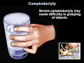 Lagu Camptodactyly - Everything You Need To Know - Dr. Nabil Ebraheim