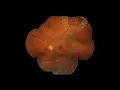 Download Lagu Horseshoe retinal tear with laser barrage