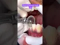 IPR BRACES Orthodontics Treatment