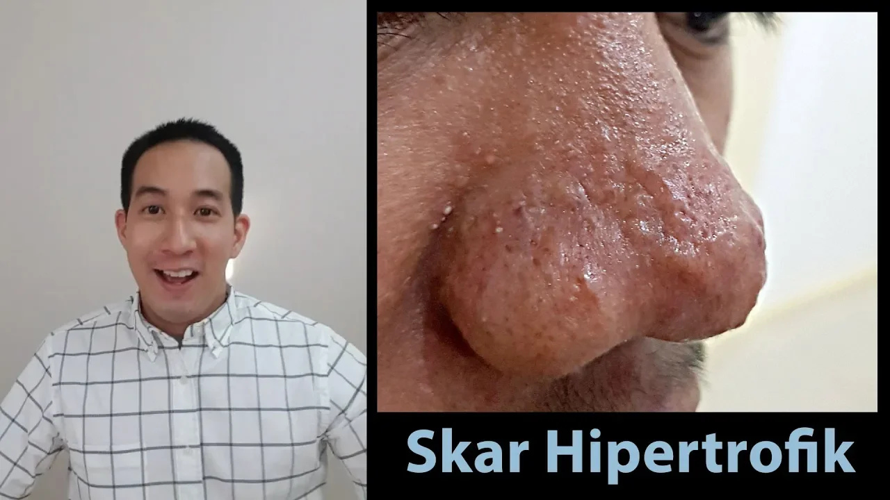 
          
          
          
            
            Jerawat di hidung ataupun dagu yang tidak kunjung hilang?
          
        . 