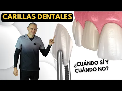 Download MP3 Carillas dentales de porcelana | Indicaciones y contraindicaciones