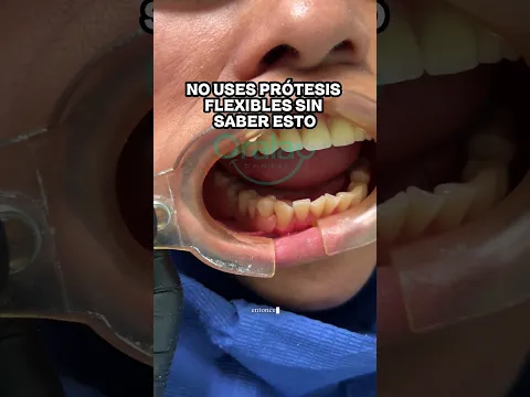 Prótesis dental flexible #protesisdental #protesisflexible