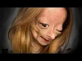 Adalia Rose YouTube Star With Rare Disorder Dead at 15