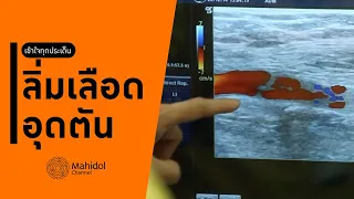 การรักษาลิ่มเลือดอุดตันในขาทำอย่างไร