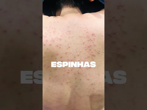 Você tem espinhas? #cabelo #acne #cabelocacheado #espinhas #cacheadas #cacheada #shortvideo #cachos