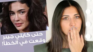 فيلر تحت العين: اثار جانبية قد تجعلكِ تعيدين التفكير بهذه الخطوة
