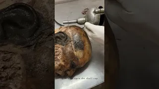 Cadaveric Dissection Of Skull For Teaching Anatomy 