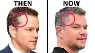 Matt Damon's Hair Transplant | Plastic Surgery Analysis