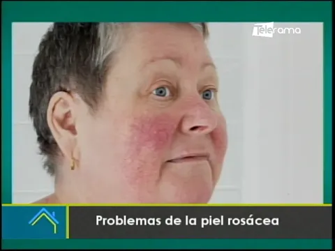 Problemas de la piel rosácea
