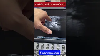  ทำไมคนไข้ถึงปวดข้อมือ และเกิดจากสาเหตุอะไร 