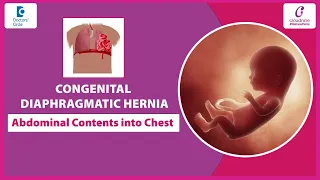 What is Congenital Diaphragmatic Hernia (CDH)? High-Risk Pregnancy Guide - Dr. Gouda Ankula