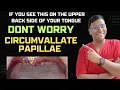 Dr Rudra If you see this on the upper back side of your tongue DON T WORRY Circumvallate Papillae