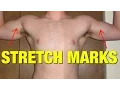 How to Remove Stretch Marks