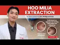 MILIA EXTRACTION SAFE EFFECTIVE MILIA REMOVAL BY A DERMATOLOGIST