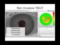 Online Seminar David Kading Future of Dry Eye with the Keratograph device