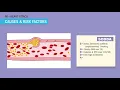Coronary Artery Disease Acute Coronary Syndrome Atherosclerosis ACS CAD