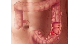 جيوب القولون دكتور علي احمد شفيق 