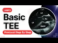 16 Views to Master in Transesophageal Echocardiography TEE