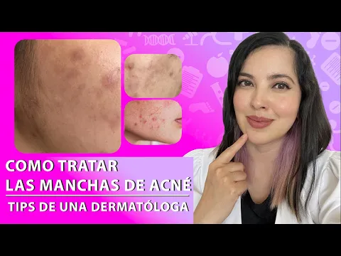 Download MP3 ¿Tienes MANCHAS POR ACNÉ?, Tips de una Dermatóloga 👩🏻‍⚕️👌🏻