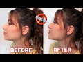 AT HOME RHINOPLASTY IN MINUTES No surgery No filler