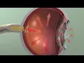 Animation Glaucoma