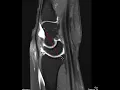 Download Lagu Scapholunate ligament rupture and DISI