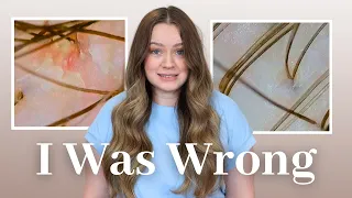 I Only Treated HALF My Scalp for 30 Days...