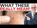 Download Lagu What Dark Spots on Your Skin Really Mean!