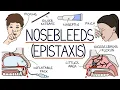 Understanding Nosebleeds Epistaxis