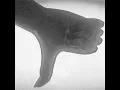 Anhedonia