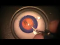 Simulated Surgery Phacoemulsification Creating Incision and Performing a Capsulorhexis