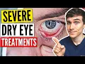Download Lagu Severe Dry Eyes Treatment - Dry Eyes Treatment Guide