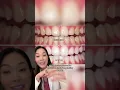 What whitening products work for different stains on teeth