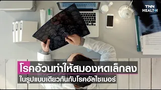  โรคอ้วนสามารถเพิ่มความเสี่ยงต่อการเกิดโรคอัลไซเมอร์ได้อย่างไร 