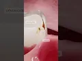 What is dental caries and how does it develop Explore dentistry in 3D