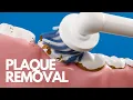 Plaque removal - Tyflow Setup