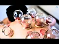 Debunking Cupping Does It Really Work The Truth Revealed