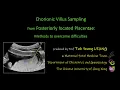 CVS from Posteriorly located Placentae Methods to overcome difficulties OBG CUHK