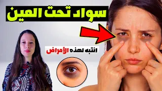 الأمراض التي تسبب سواد تحت العين دندنها