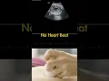 Download Lagu Ultrasound showing a  9 weeks fetus with no Heart Beat