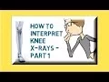 How to interpret knee X-rays - Part 1