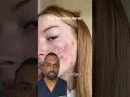 How does ACCUTANE work Dr Somji Explains