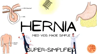 Inguinal hernia (embryology, types, clinical features, examination, surgeries) | Surgery SIMPLIFIED