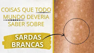 Coisas que todo mundo deveria saber sobre sardas brancas